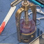 First Biceps Autograft Patch Augmentation for Arthroscopic Rotator Cuff Repair in St. Louis performed at Mercy