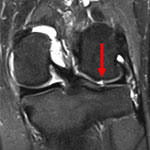 Cartilage Repair and Joint Preservation Program